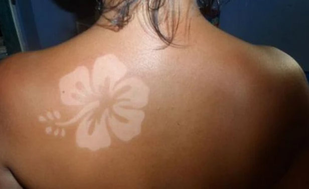 요즘 유행한다는 ‘선번 타투(sunburn tattoo)’의 위험성 - Los Angeles - 1