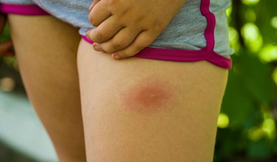 Various Types of Bugs That Bite People in America - Los Angeles - 1