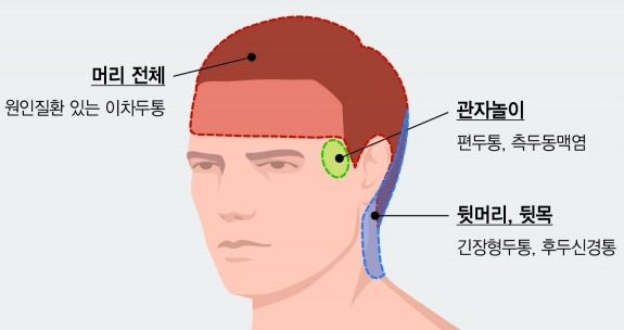 원인이 뚜렷한 두통과 몸 상태 때문에 생기는 두통의 차이  - San Francisco - 1