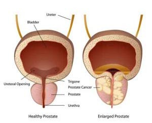 Former US President Biden Diagnosed with Prostate Cancer "Cancer Spread to Bones" - Chicago - 2