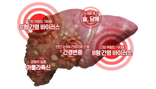 과음하면서 간경변이 있는 사람은 간암 걸릴 가능성이 높다 - Orlando - 1