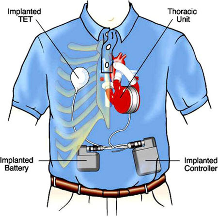 People Surviving with New Technology Artificial Hearts Without Heartbeats - San Jose - 3