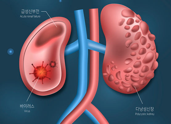 젊다고 안심할 수 없는 신장질환 항상 관리해야 하는 이유 - Montgomery - 1