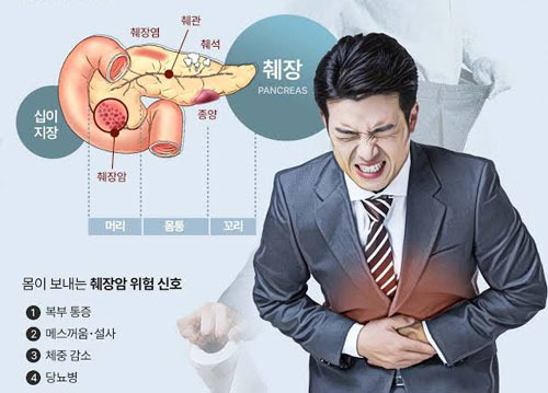 췌장암은 왜 발견했을 때 이미 늦었다는 말을 할까 - Annandale - 1