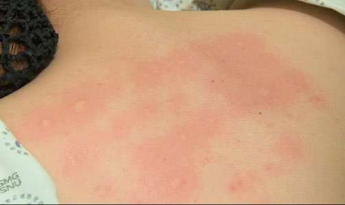 Torrance Bugs and Allergies — Things to Know Before Moving - Torrance - 1