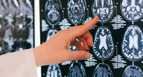 What is the Effect of Dopamine on the Human Body? - Los Angeles - 1